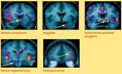 fMRIs von Hirnregionen des Lust- und Belohnungssystems